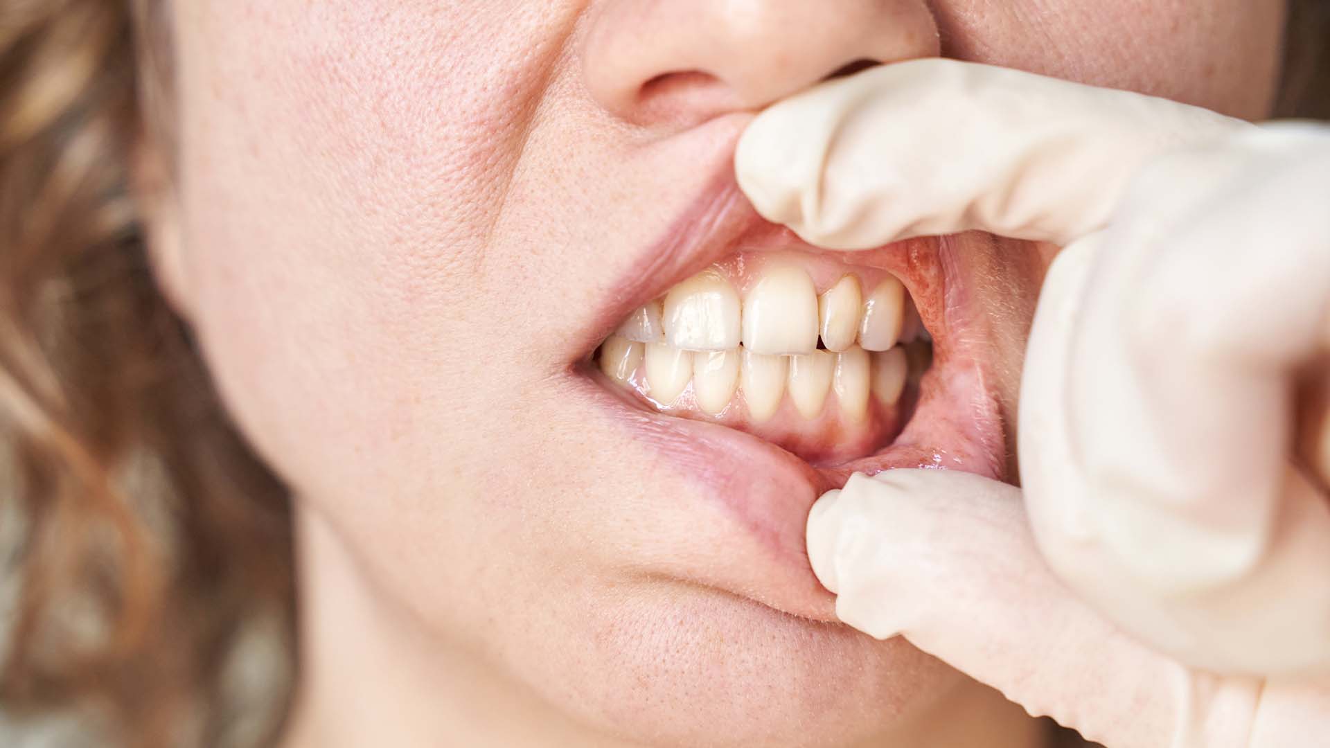 Gengive che Sanguinano e Denti Mobili: Cosa Fare e Quando Preoccuparsi